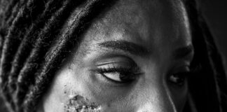 Antonette Currie Shares Her Story Of Living With Lupus