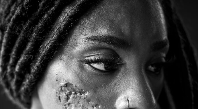 Antonette Currie Shares Her Story Of Living With Lupus